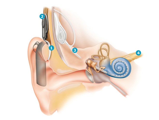cochlear-implant-3
